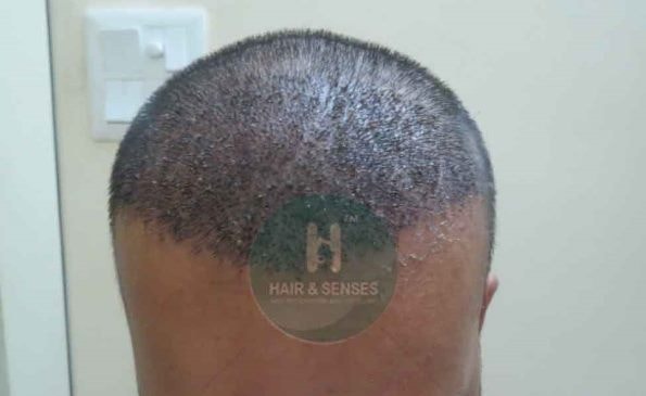 Hairline Designing